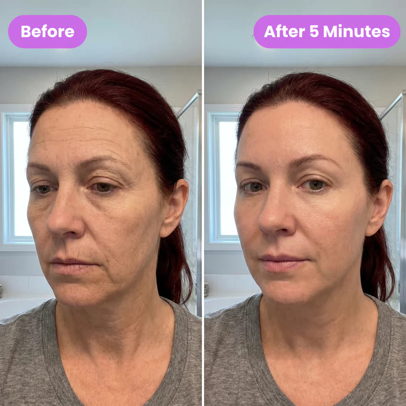Before and after eye lift 1