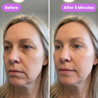 Before and after eye lift 2