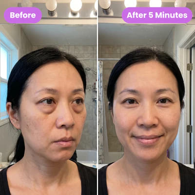 Before and after eye lift 3
