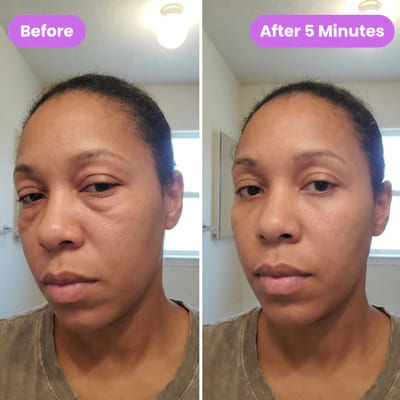 Before and after eye lift 4
